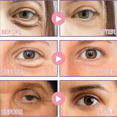 Microneedle Eye Patches for Bags & Dark Circles